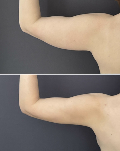 before-after-liposuction-arms-10