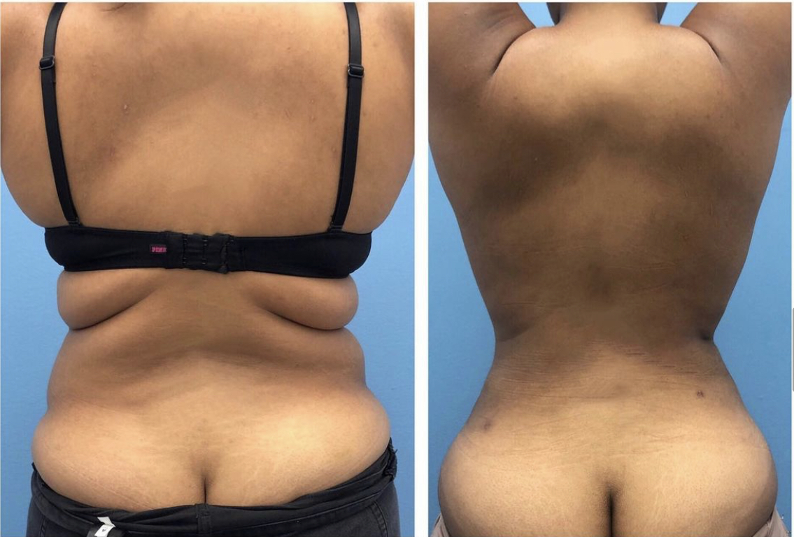 Back Liposuction Before and After Photos