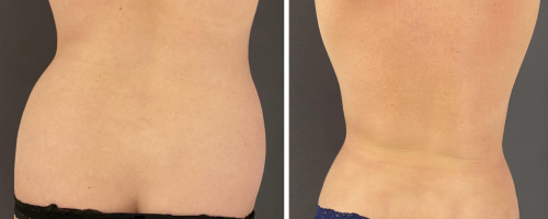 Back-Liposuction-before-and-after-photo-041923-1