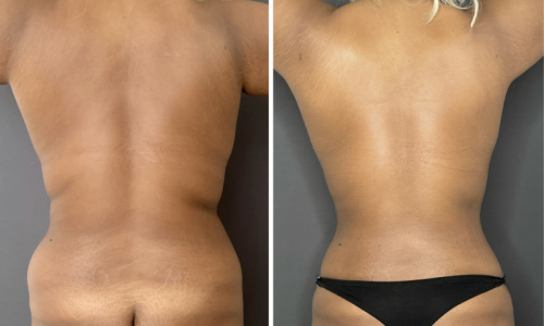 Before-After-Liposuction-NYC-5