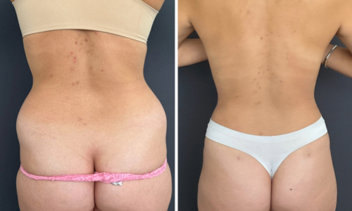 Before-After-Liposuction-NYC-6