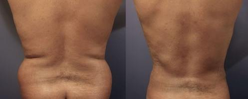 Before-After-back-liposution-male-min