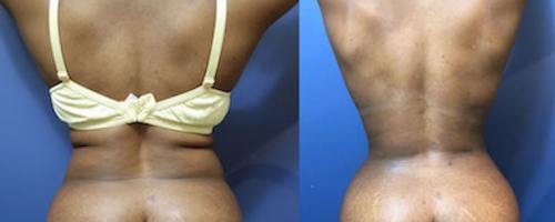 Before-After-female-back-liposuction-3-min