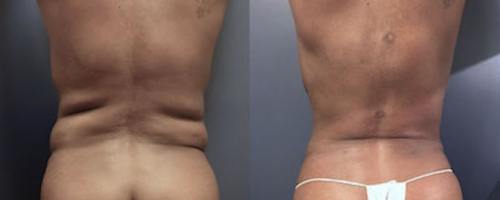 Before-After-female-back-liposuction-4-min