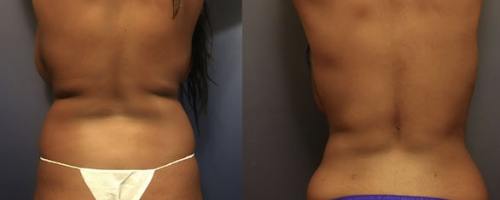 Before-After-female-back-liposuction-min
