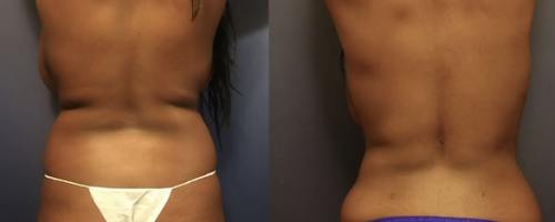 Before-After-female-back-liposuction-min