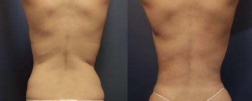Before-After-female-back-liposuction-young-min