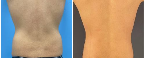 back-liposuction-before-after-1