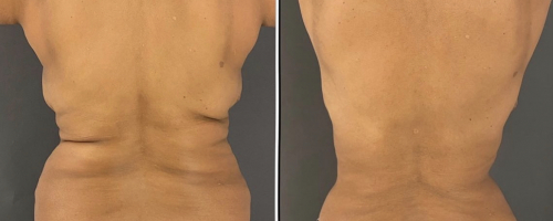 back-liposuction-before-after-2