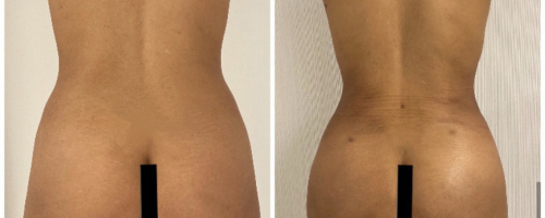 back-liposuction-before-after-3
