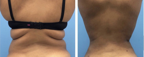 back-liposuction-before-after-4