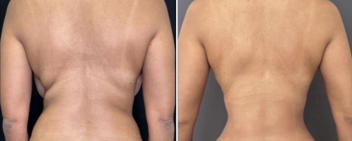 back-liposuction-nyc-back-before-after-8