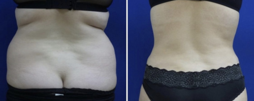 back-liposuction-nyc-back-before-after-female-6