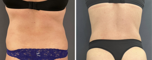 back-liposuction-nyc-back-before-after-female-7