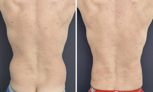 back-liposuction-nyc-back-before-after-female-8