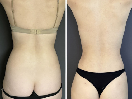 back-liposuction-nyc-back-before-after-female-9