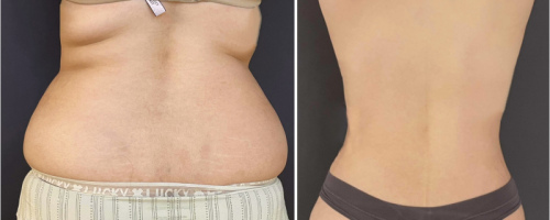 liposuction-back-before-after-female-5