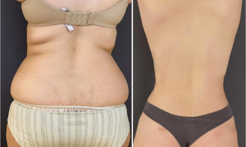 liposuction-back-before-after-female-5