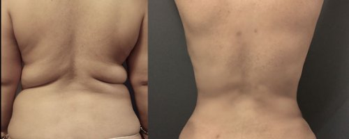 liposuction-back-before-after-female