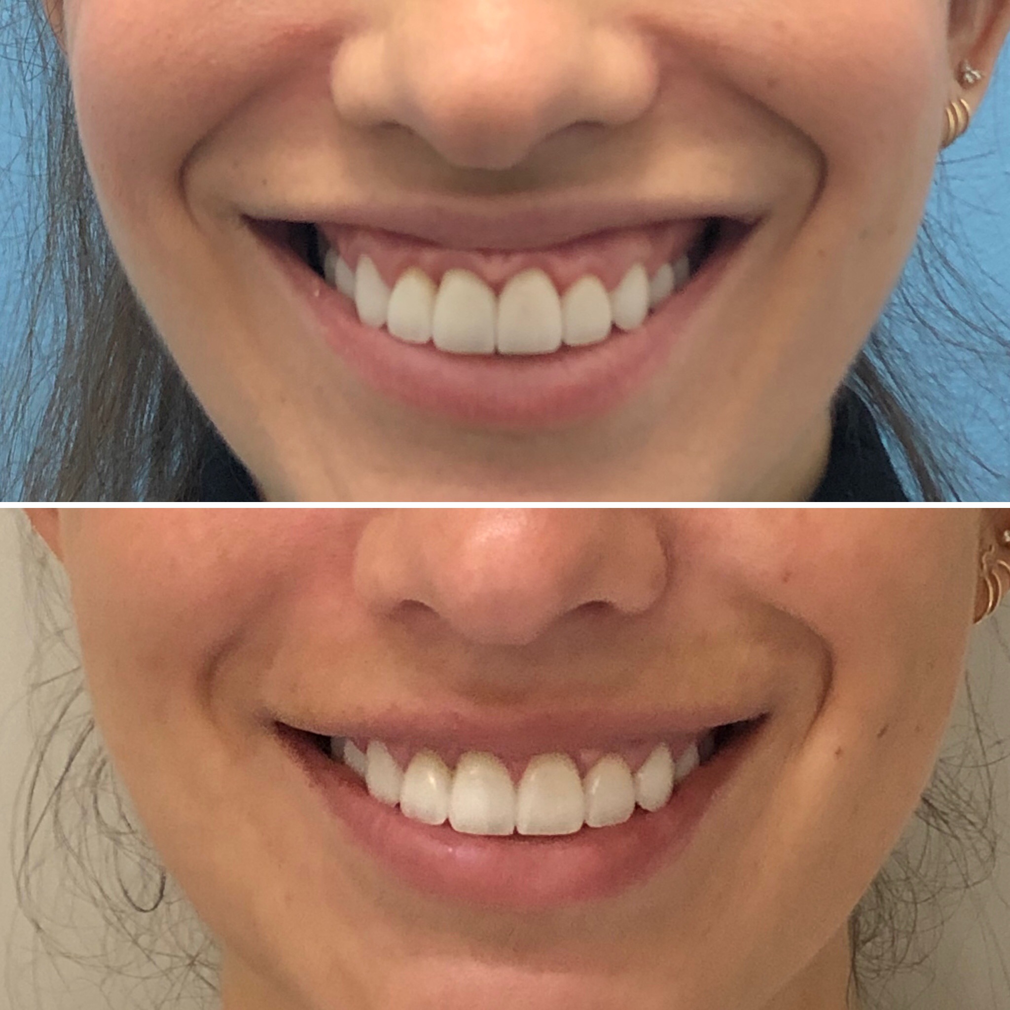 Botox Gummy Smile Before And After Photos