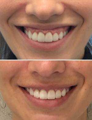 botox-gummy-smile-before-after-1