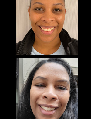 botox-gummy-smile-before-after-2
