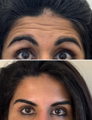 botox-before-after-3