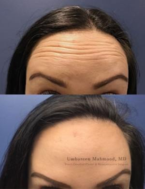 botox-female-forehead-min-1