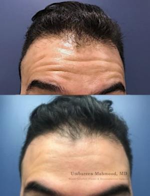 male-botox-forehead-min