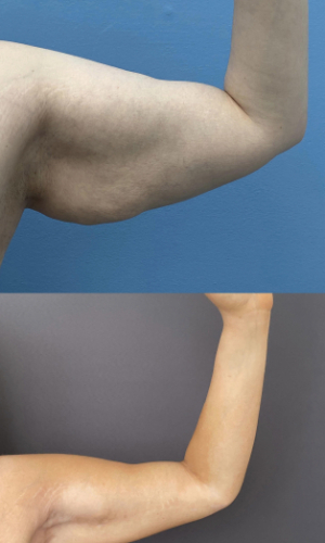brachioplasty-before-and-after-1