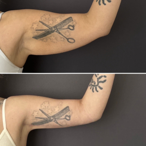 brachioplasty-before-and-after-3