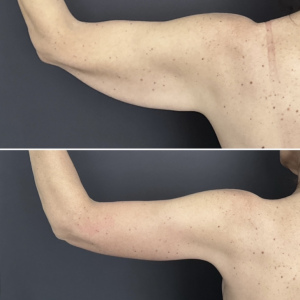 brachioplasty-before-and-after-4