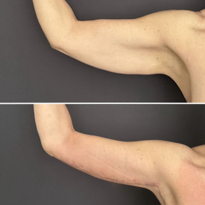 brachioplasty-nyc-before-and-after-5