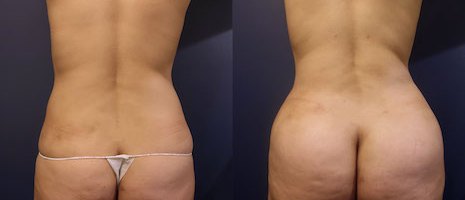 brazilian-butt-lift-before-after-3