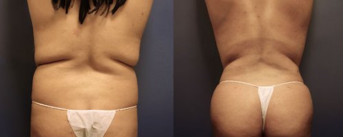 brazilian-butt-lift-before-after-4