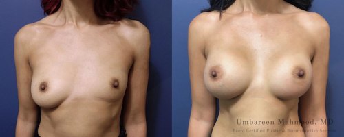 10-breast-augmentation-before-after