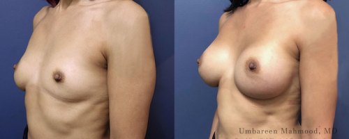 11-breast-augmentation-before-after