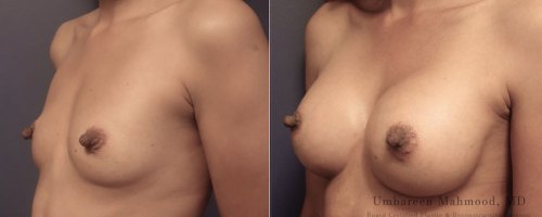 12-breast-augmentation-before-after