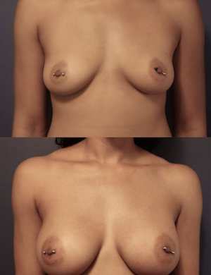 14-breast-augmentation-before-after
