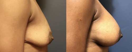 15-breast-augmentation-before-after