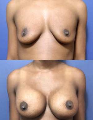 16-breast-augmentation-before-after