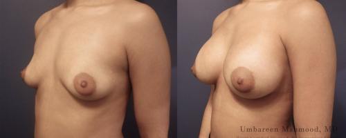 17-breast-augmentation-before-after