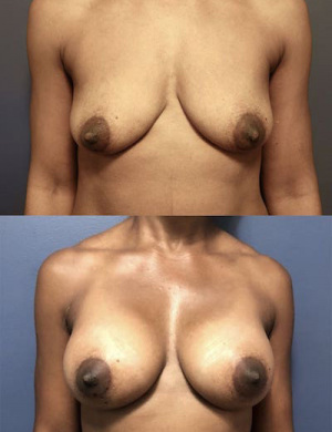 19-breast-augmentation-before-after-1