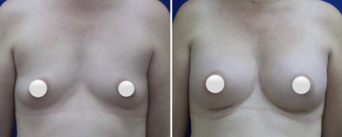 1_breast-augmentation-before-after-1