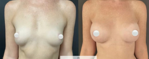 1_breast-augmentation-before-after-2