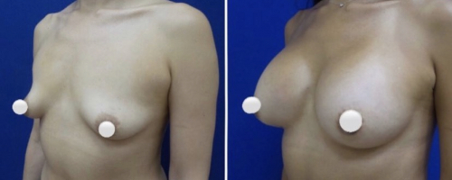 1_breast-augmentation-before-after-4