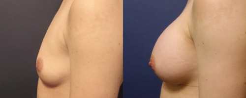 21-breast-augmentation-before-after