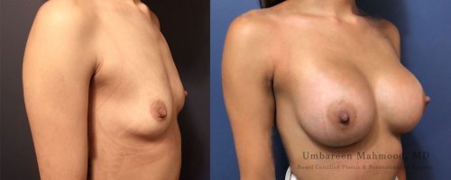 22-breast-augmentation-before-after