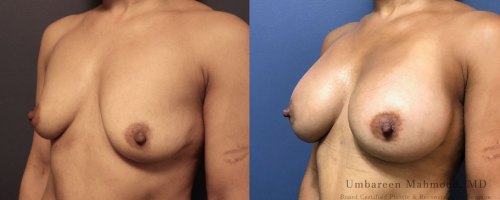 24-breast-augmentation-before-after