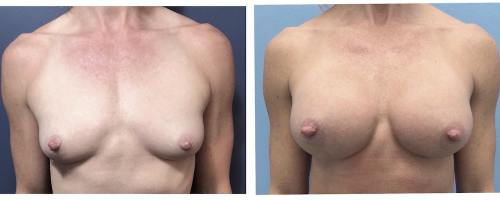 25-breast-augmentation-before-after